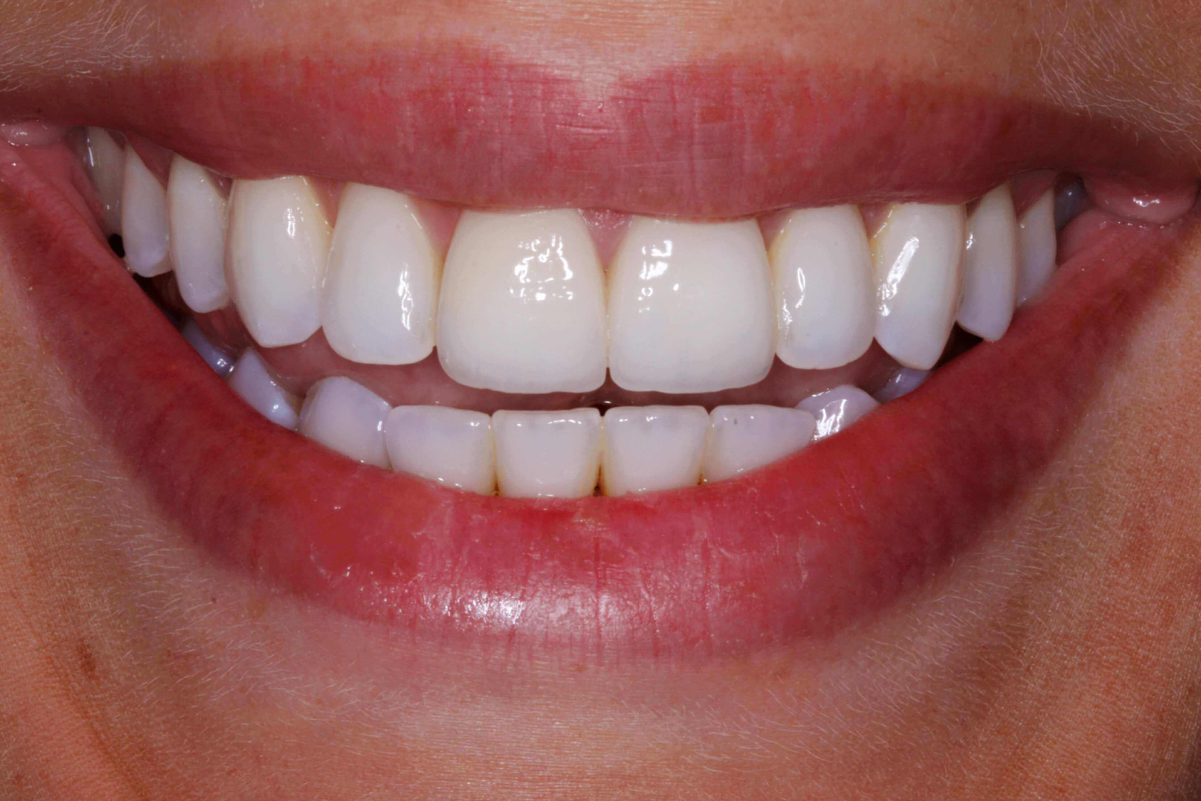 Image of teeth after treatment